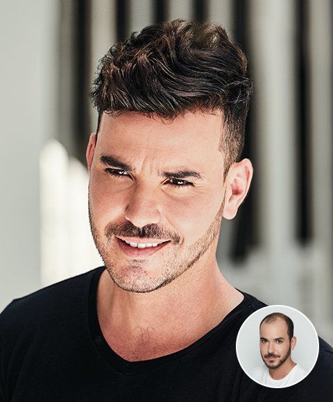 hair replacement services