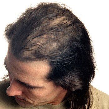 man with bald patches on scalp