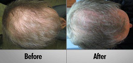 before and after of hair loss therapy