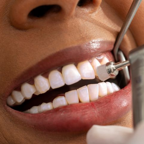 A woman is getting her teeth examined by a dentist.