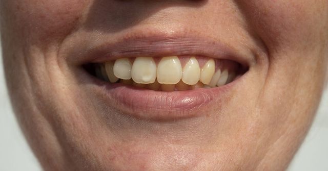 tooth spot 640w - Holistic Dentistry Advantages-- Aleteia