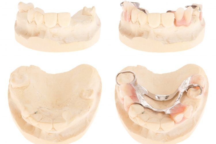 Dentures placed in 3D model