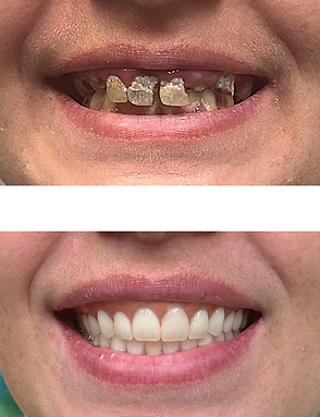 Before and after photos of a mouth: decayed teeth replaced by a bright, healthy smile.