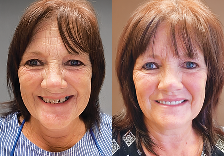 Side-by-side comparison of a woman's smile before and after dental work, showing brighter, improved teeth.