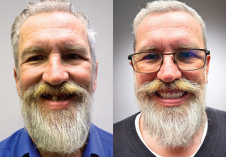 Side-by-side comparison of a man with missing teeth on the left and a full smile with new teeth on the right.