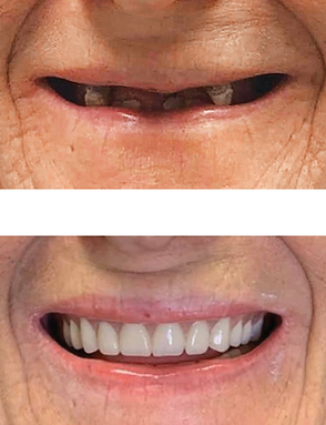 Before and after showing a mouth with missing teeth, then with a full set of new teeth.