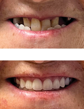 Before and after photos of a person's teeth. Top: damaged teeth. Bottom: bright, complete smile.