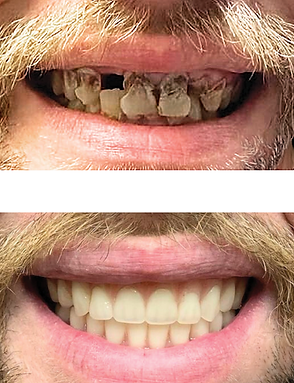 Before and after photos of a mouth: decayed teeth compared to a bright, healthy smile.