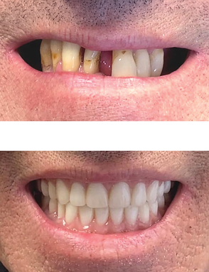 Before and after photos of a person's teeth, showing significant improvement from damaged and discolored to a healthy white smile.