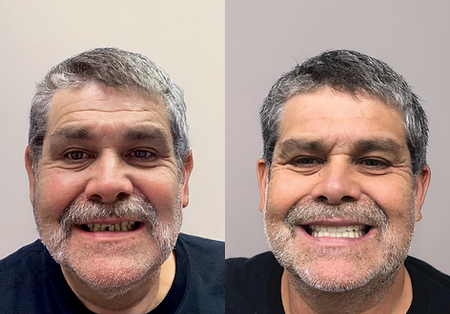 Before-and-after of a man's smile. The first shows missing teeth, the second shows a full, bright smile.