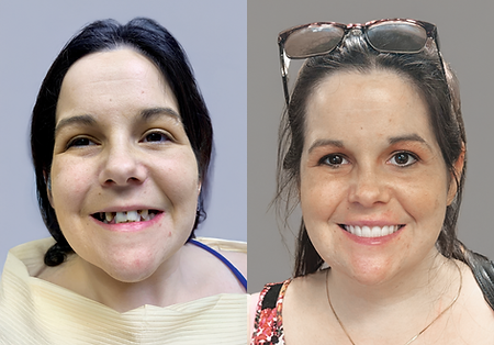 Side-by-side photos of a woman before and after a dental procedure, showing a dramatic improvement in her smile.