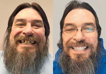 Side-by-side comparison: Man with missing teeth smiling vs. man with new teeth smiling.