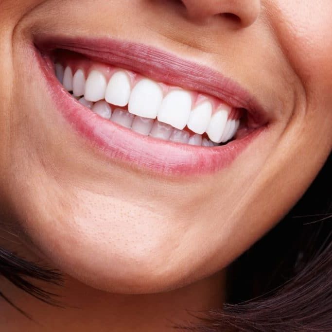 Porcelain Veneers