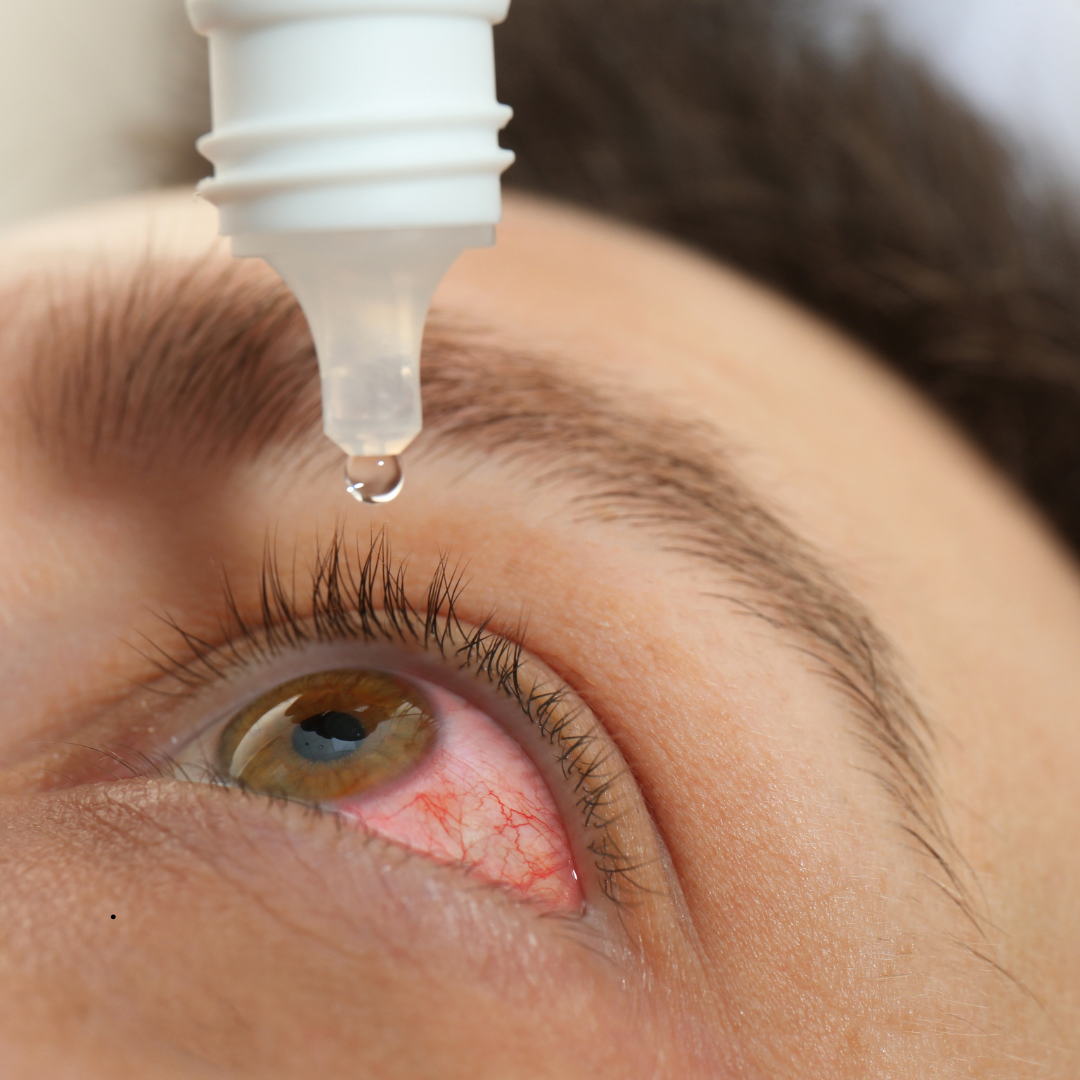 Person applying eye drops to a red, irritated eye.