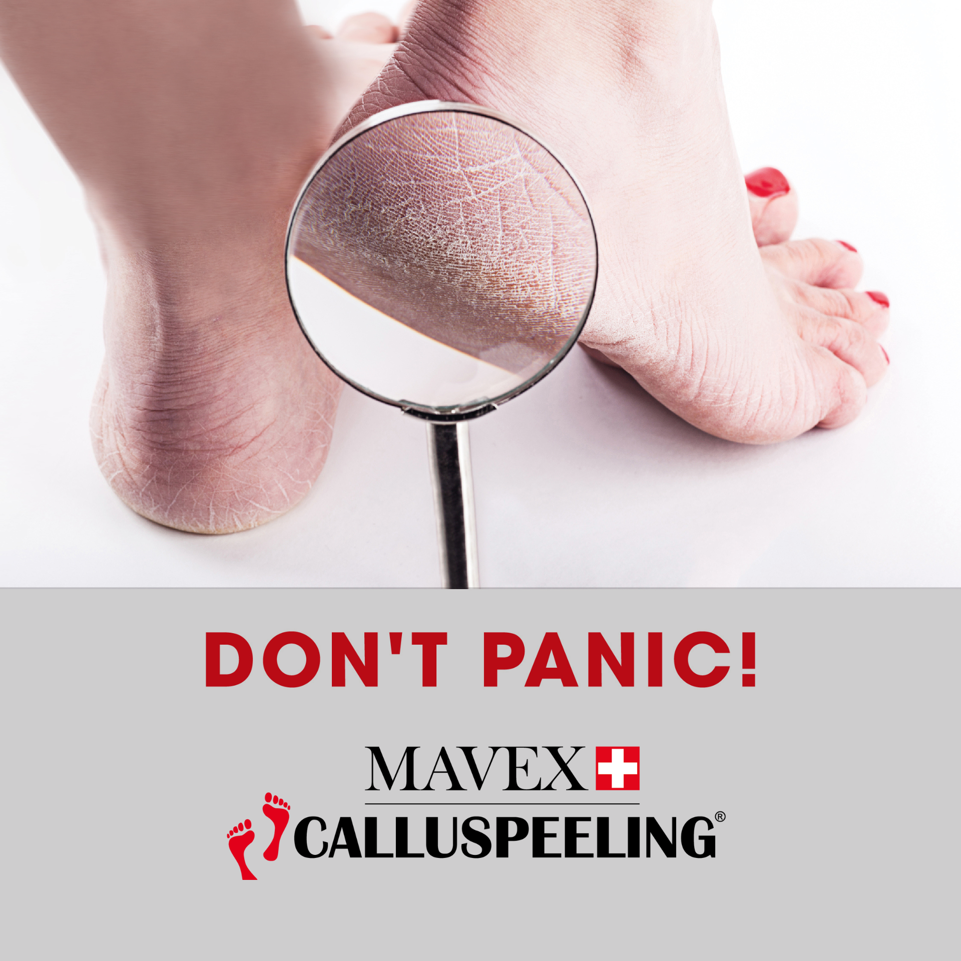 Una lente di ingrandimento mostra il tallone screpolato del piede di una donna