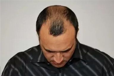 A man with a bald head is wearing a striped shirt and looking down.