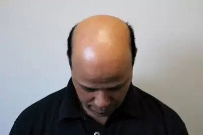 A bald man in a black shirt is looking down at his head.