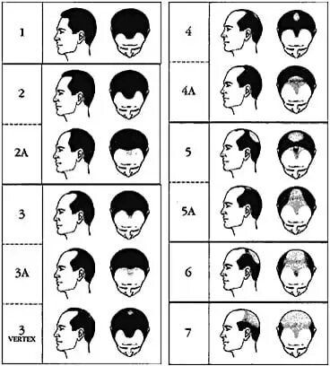 A black and white drawing of a man 's head with different stages of hair loss.