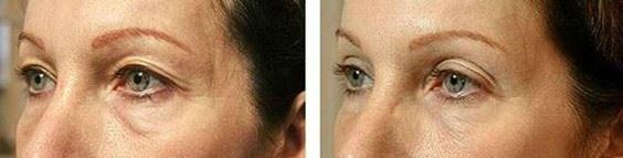 Laser Skin Tightening