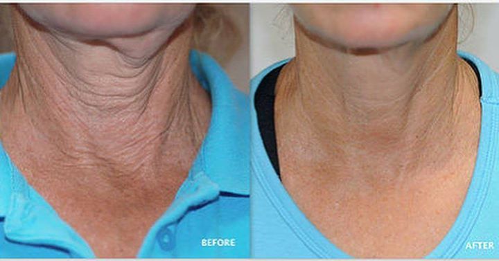 Laser Skin Tightening