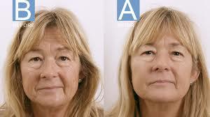 Laser Skin Tightening
