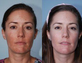 Melasma Before and After Photo