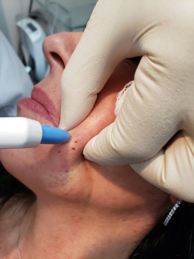 Agnes-Fat-Removal-Boston