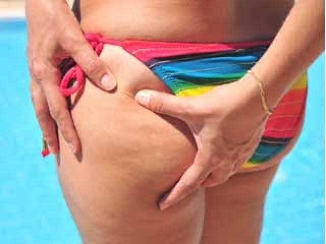 Cellulite Treatment