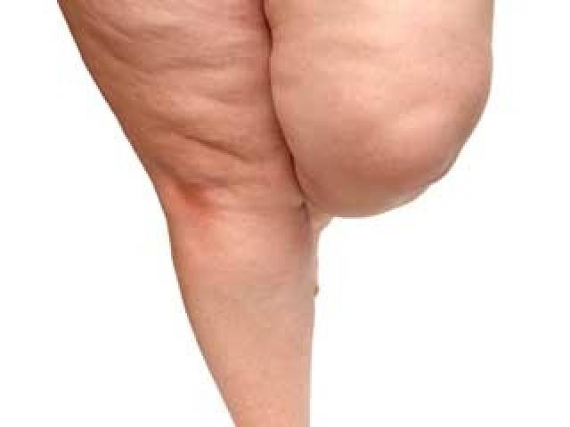 Cellulite Treatment