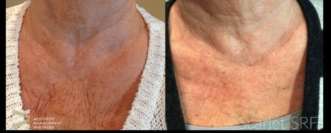 Decolletage-Chest-MicroneedlingTreatment