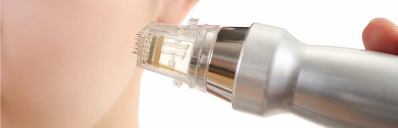 5 Things About RF Microneedling