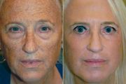 sundamage-treament-before-after