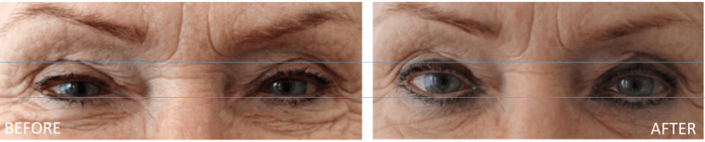 Scarlet Treatment for Eye Wrinkles and loose skin