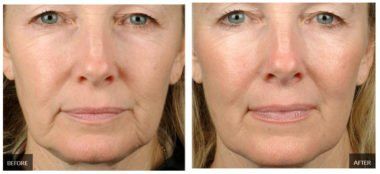 RF-Microneedling-Collagen-Scarlet-Morpheus