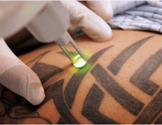 Laser Tattoo Removal