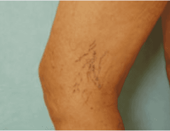 Spider Vein Removal for Legs
