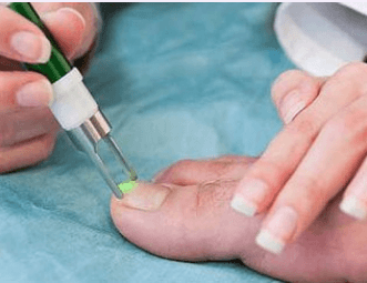 Laser Nail Fungus Removal