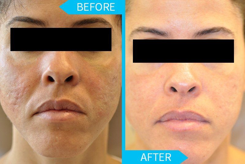 rf Microneedling for acne scars