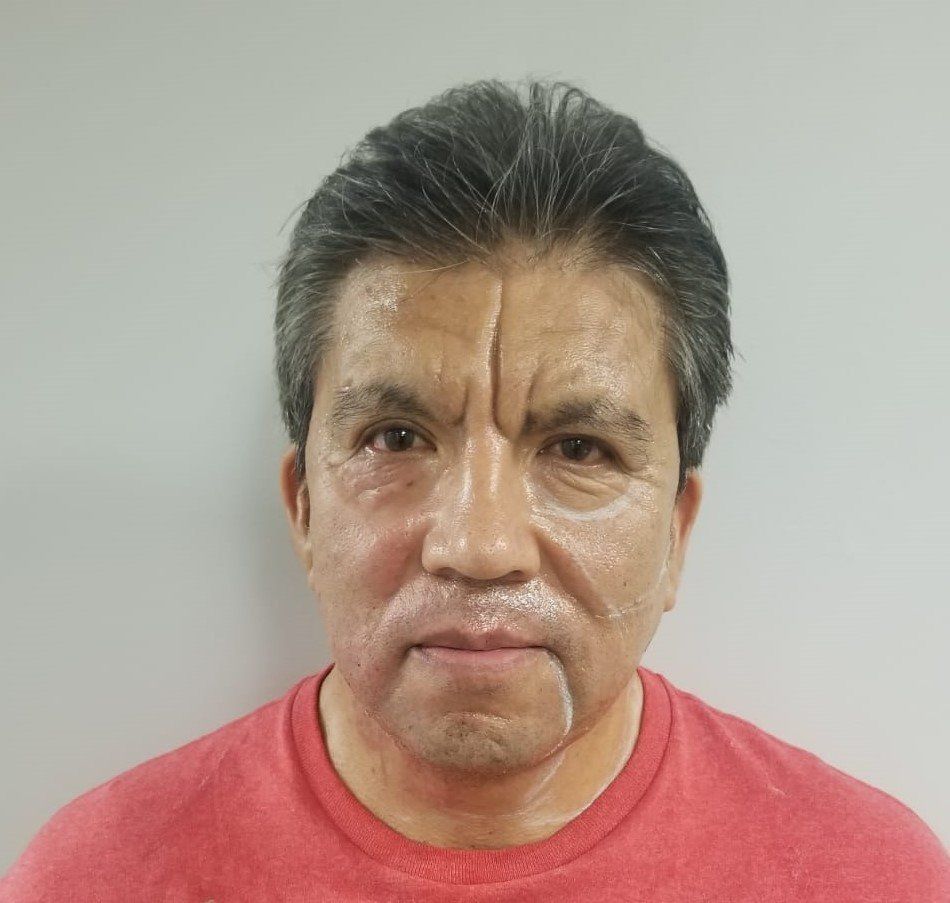 RF-Microneedling-Scarlet-Boston-RI