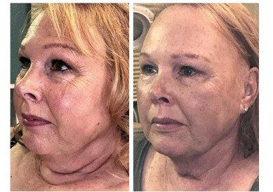 Agnes Laser Treatment