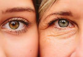 Agnes-Eye-Bags-Wrinkles