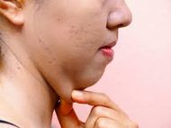 Double-Chin-Fat-Removal-Non-Surgical