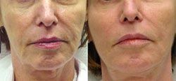 Laser Skin Tightening