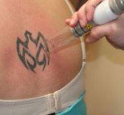 Laser Tattoo Removal Boston Ri Over 20yrs Exp