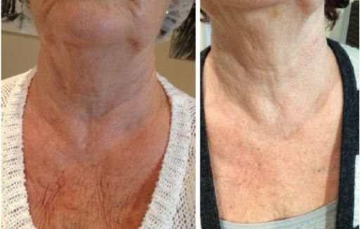 remove-chest-wrinkles