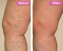 abdomen-fat-removal