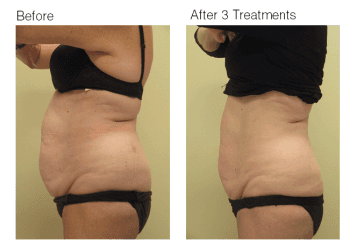 Ultrashape belly fat removal