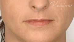 Juvederm for lips