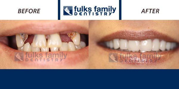 A before and after photo of a woman 's teeth from fulks family dentistry