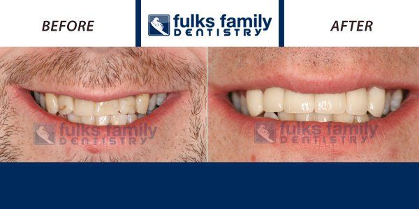 A before and after picture of a man 's teeth from fulks family dentistry